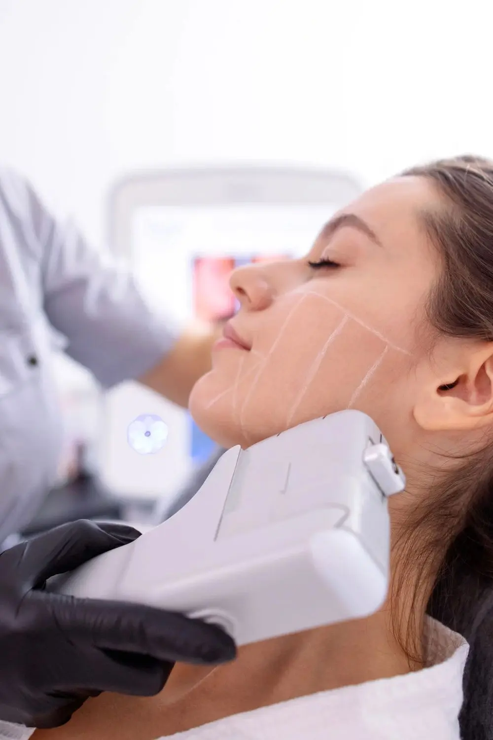 HIFU — zabieg liftingujący w klinice DermaElite